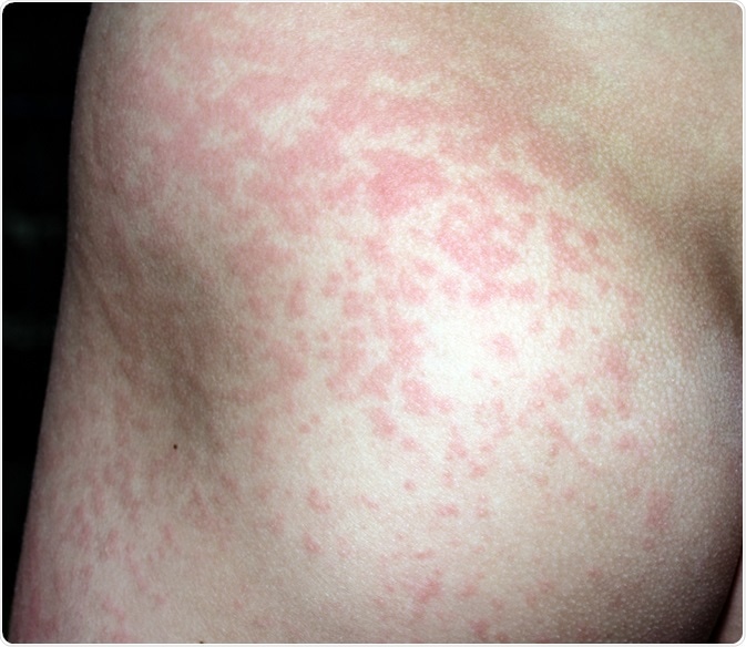 Fifth Disease Signs and Symptoms