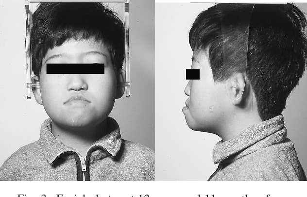 Dental management of 49,XXXXY syndrome with taurodontism: A case ...