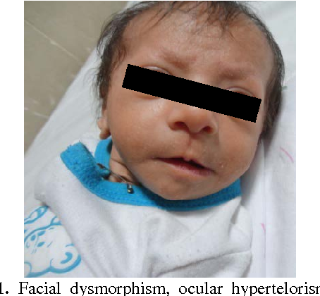 Figure 1 from Neonatal diagnosis of 49, XXXXY syndrome | Semantic ...