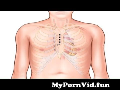 Aortic Valve Replacement with a Pericardial Tissue Valve from ...