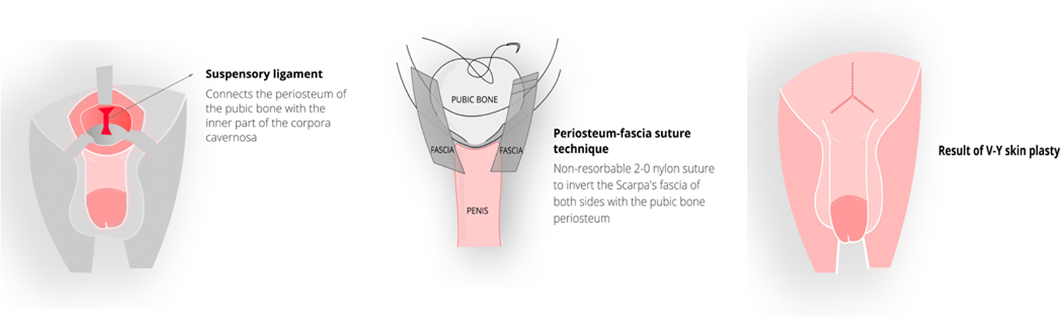 Cosmetic penile enhancement surgery: a 3-year single-centre ...