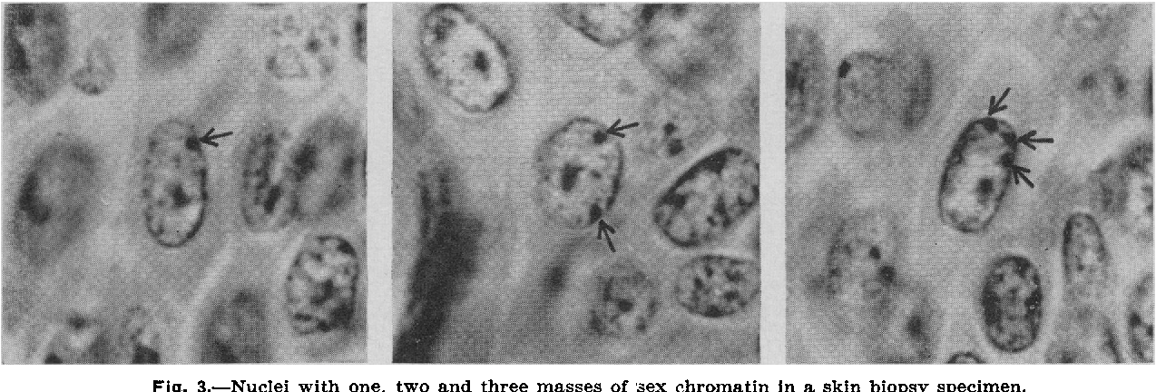 CAIALDEMM3 AN XXXX SEX CHROMOSOME COMPLEX IN TWO MENTALLY ...