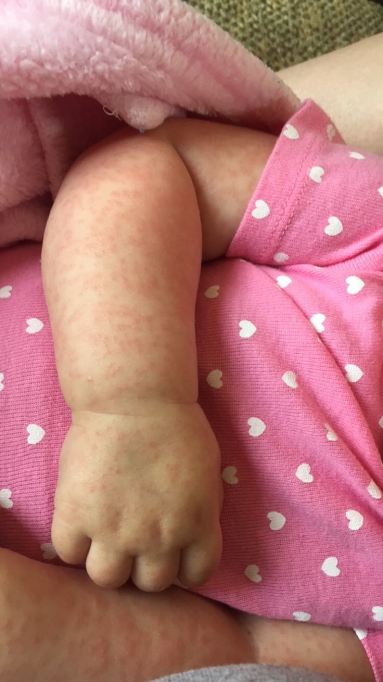 A 5-month-old baby in Alabama got the measles