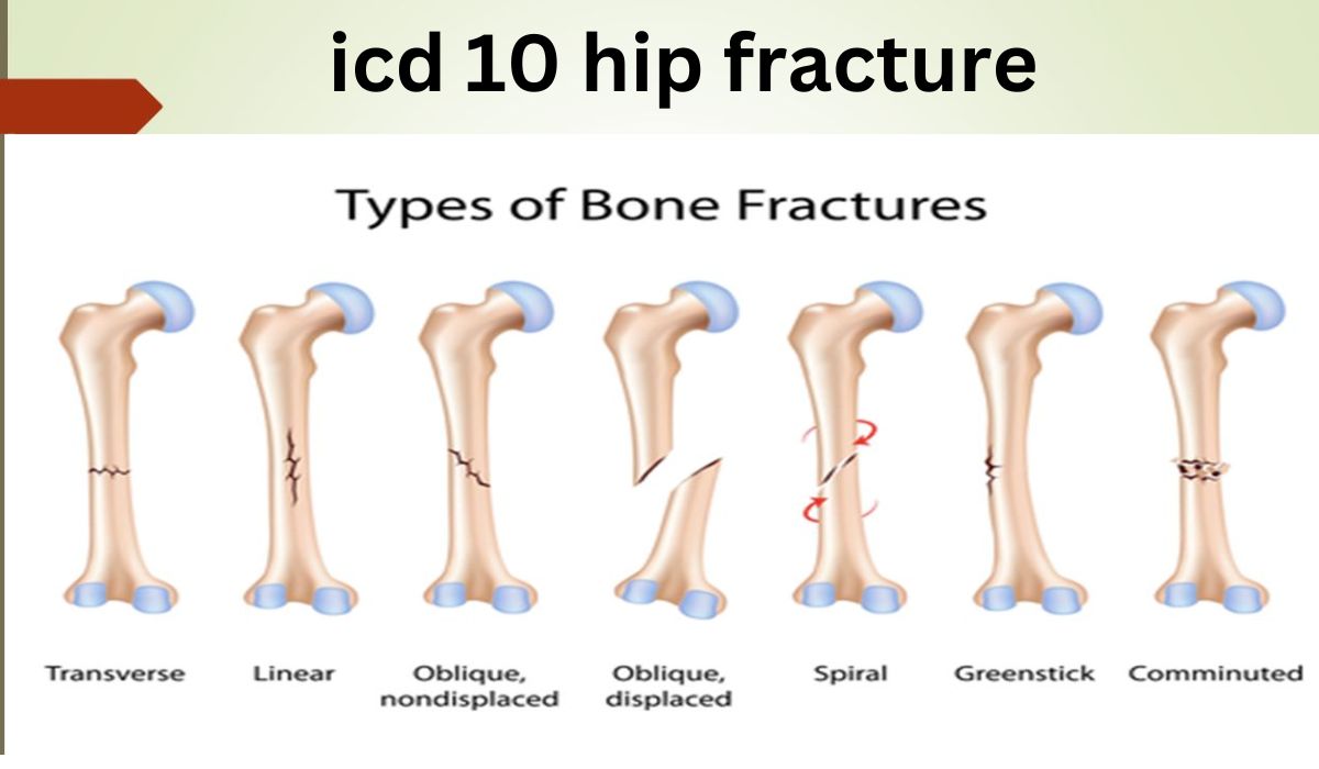 Hip Fracture ICD 10 Code - bizpostlive