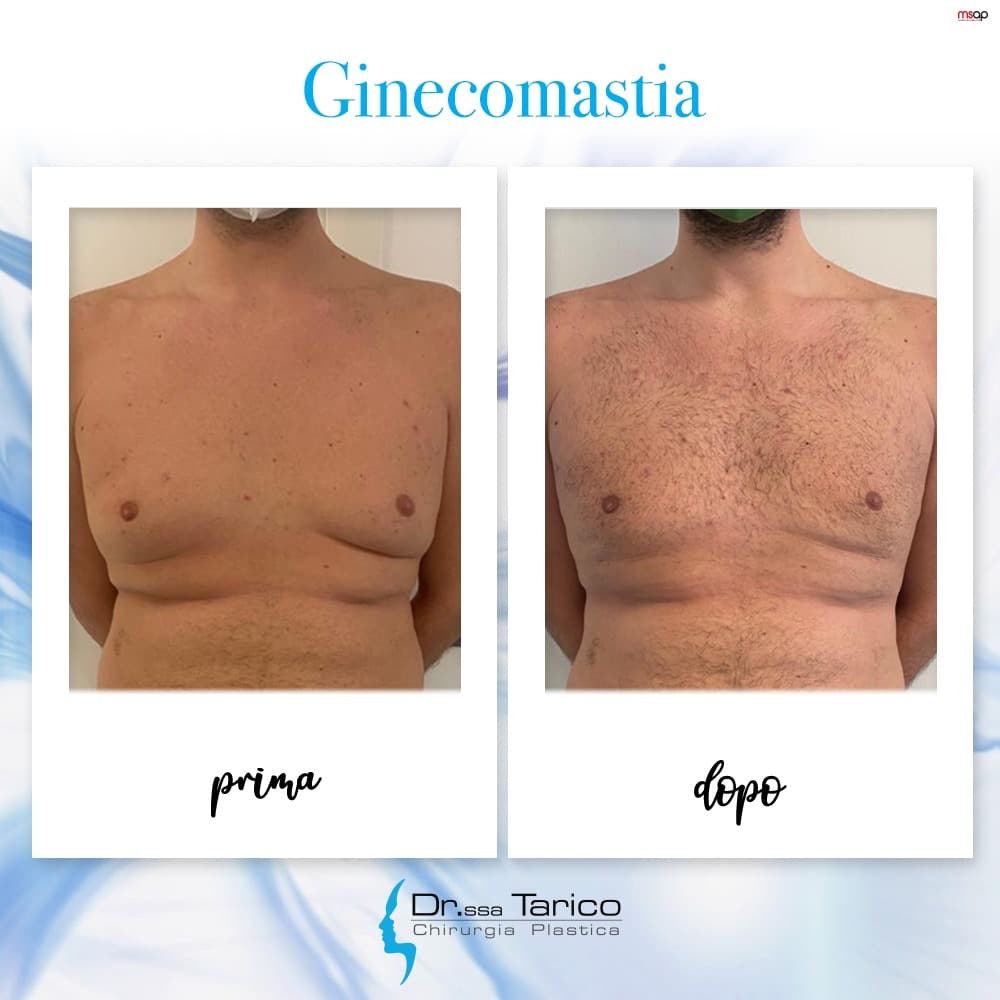 Prima e dopo Ginecomastia - Chirurgia Plastica - Catania - Sicilia