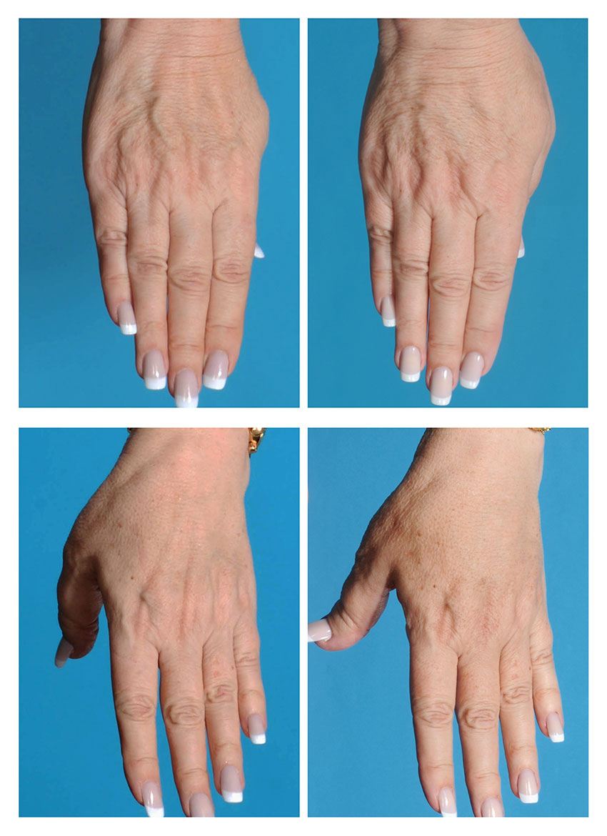 Hand Rejuvenation Before and After Photos