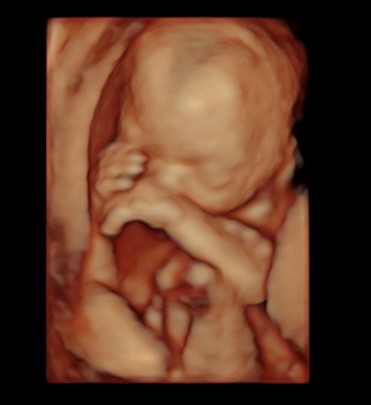 18 week ultrasound - Reveal 3D/4D Ultrasound Studio