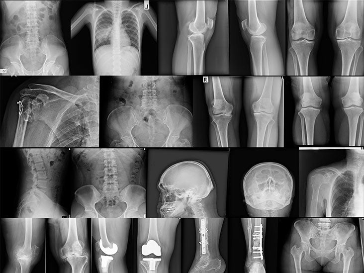 Bones: Types, structure, and function