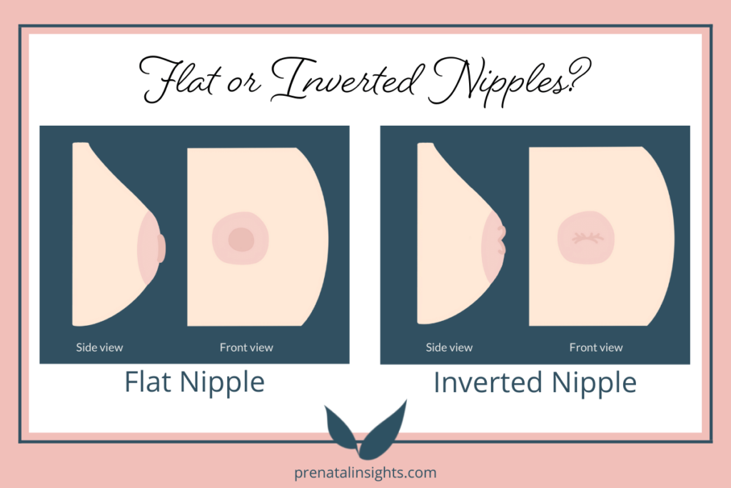 Breastfeeding with Flat or Inverted Nipples: 10 Tricks to Make It ...