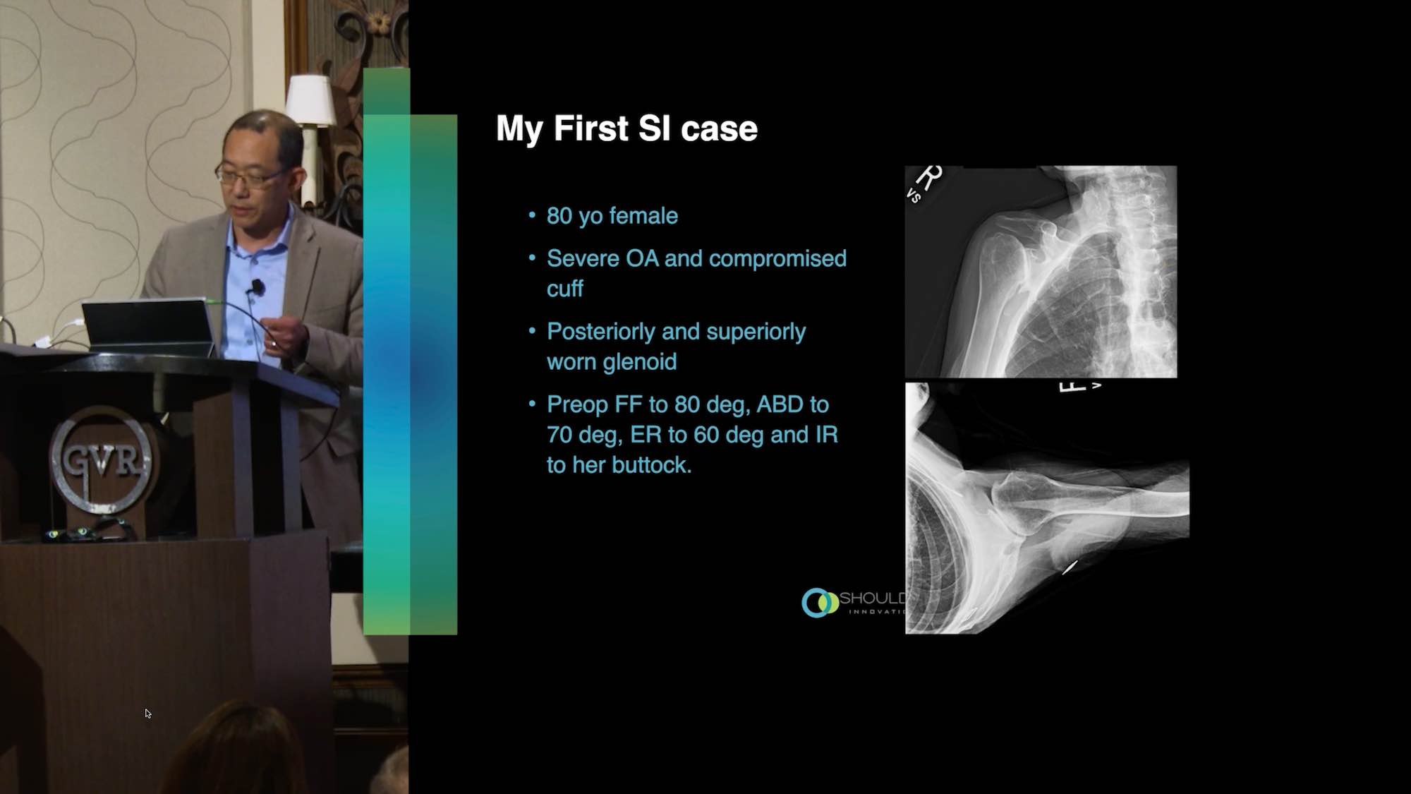 Dr. Galen Kam InSet™ Reverse Total Shoulder Video Presentation