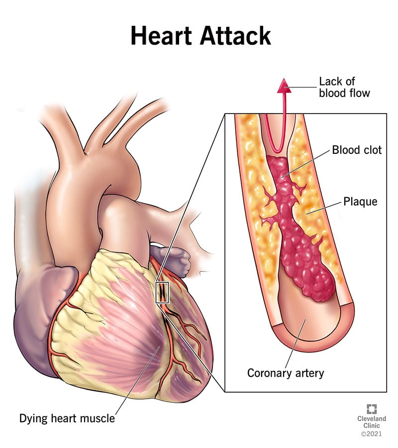 Heart Attack: Symptoms and Treatment