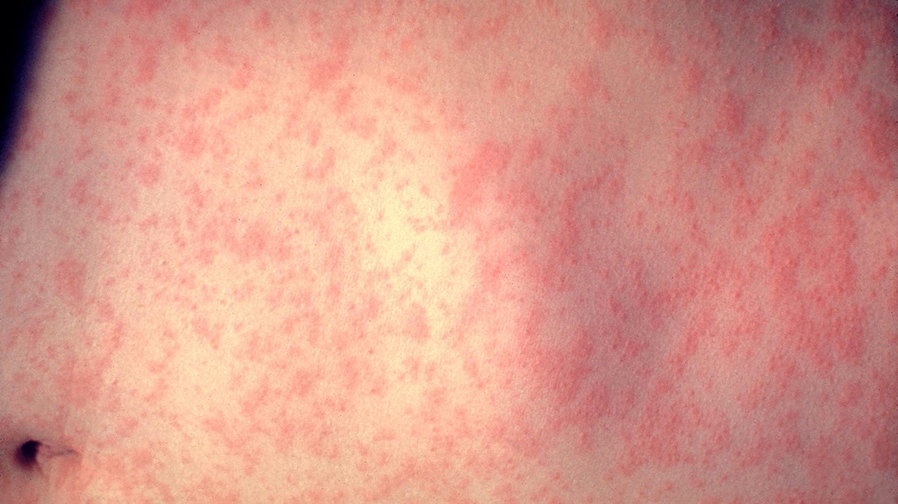 Measles: Causes, symptoms, and treatment