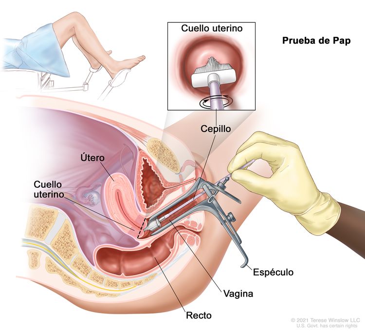 Tratamiento del cáncer de vagina - NCI