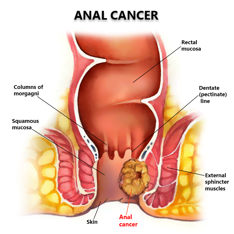 Anal Cancer: Are You at Risk? Manhattan Gastroenterology