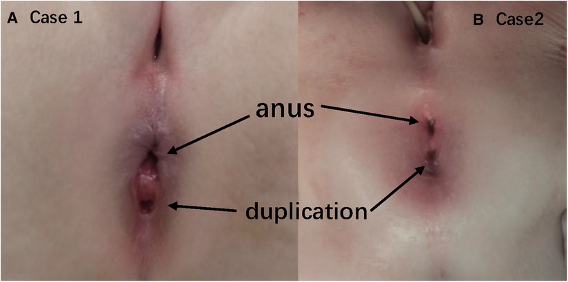 Frontiers | Case Report: Anal canal duplication associated with ...