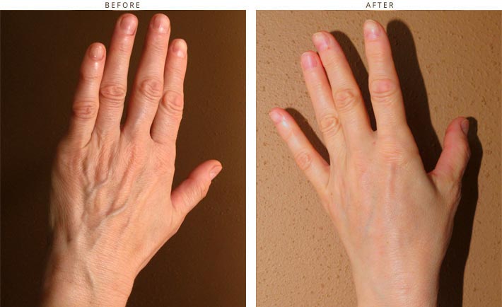 Hand Rejuvenation – Before and After Pictures * | Dr Turowski ...