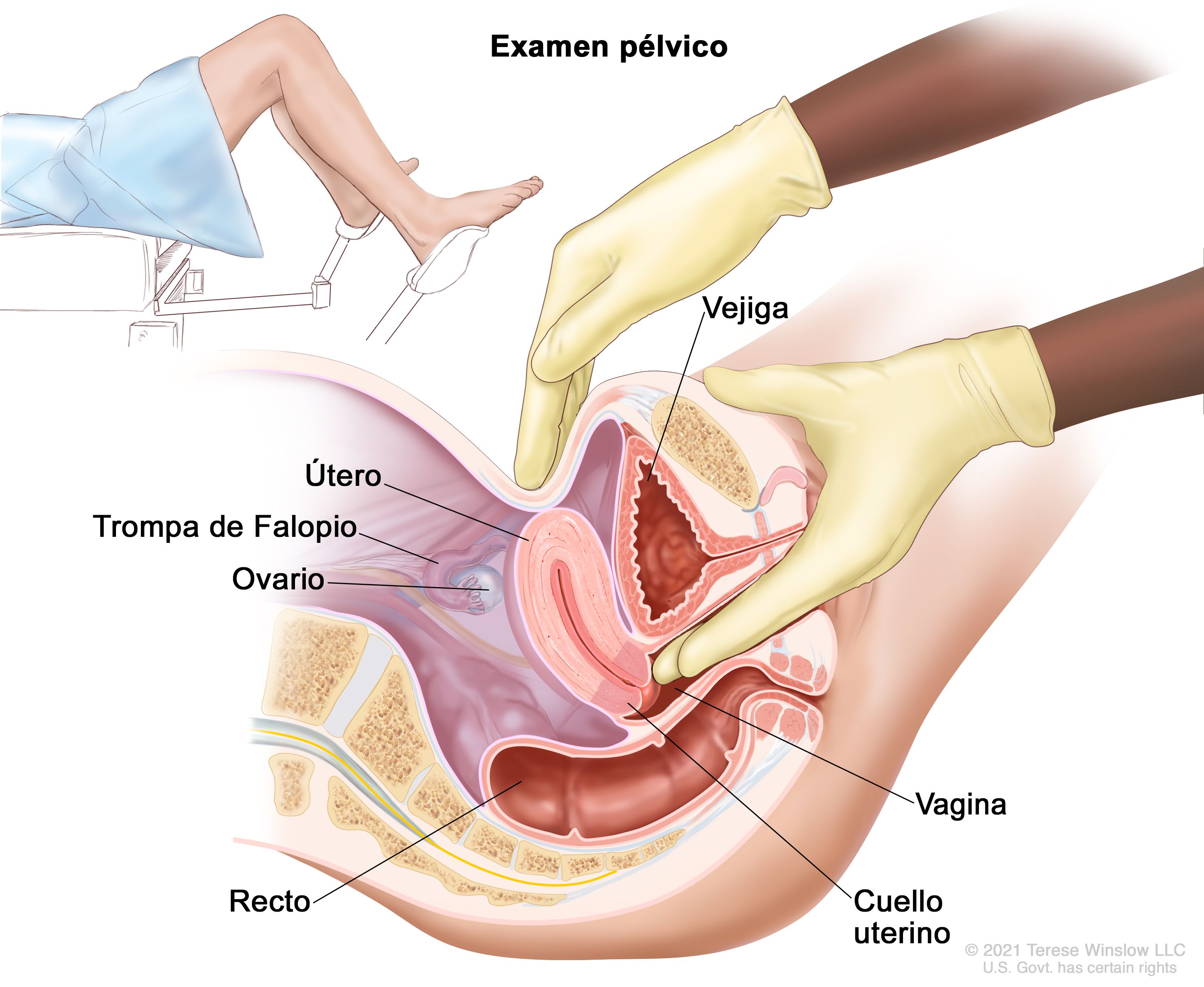 Tratamiento del cáncer de vagina - NCI