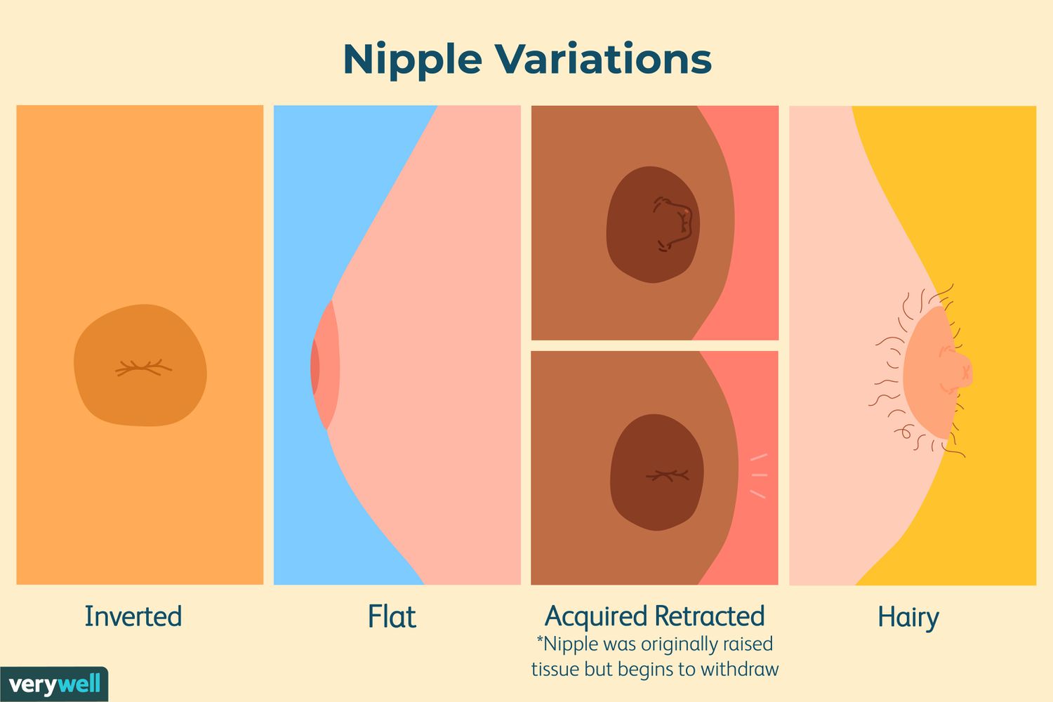Types of Nipples: Protruding, Flat, Inverted, Unclassified
