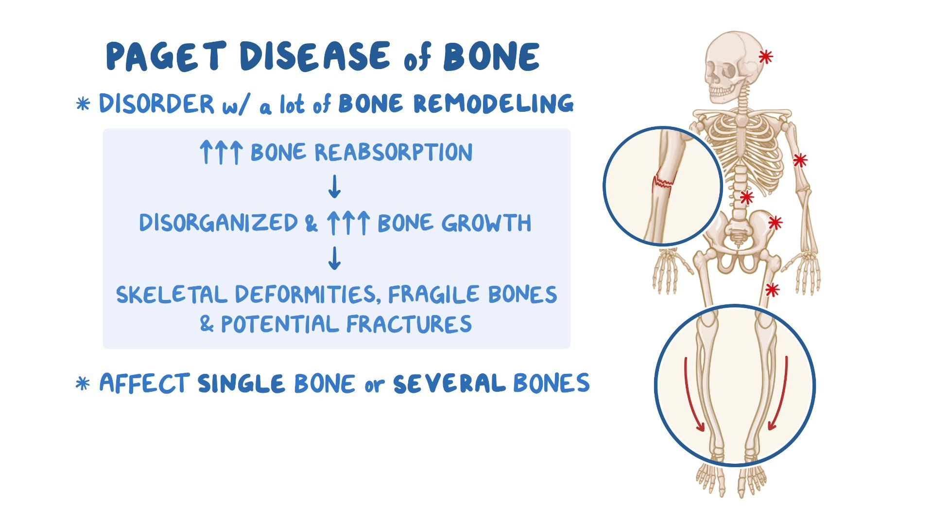 Paget disease of bone: Nursing - Osmosis Video Library