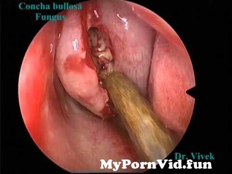 Dr. Vivek saindran ENT | Surgery Videos| Pushpagiri Medical ...