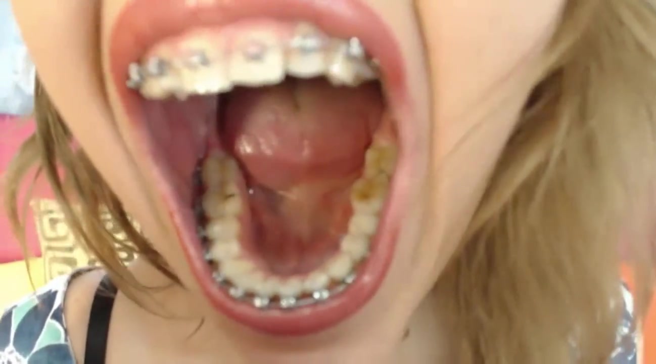 Braces Girl Webcam Mouth Tour - ThisVid.com