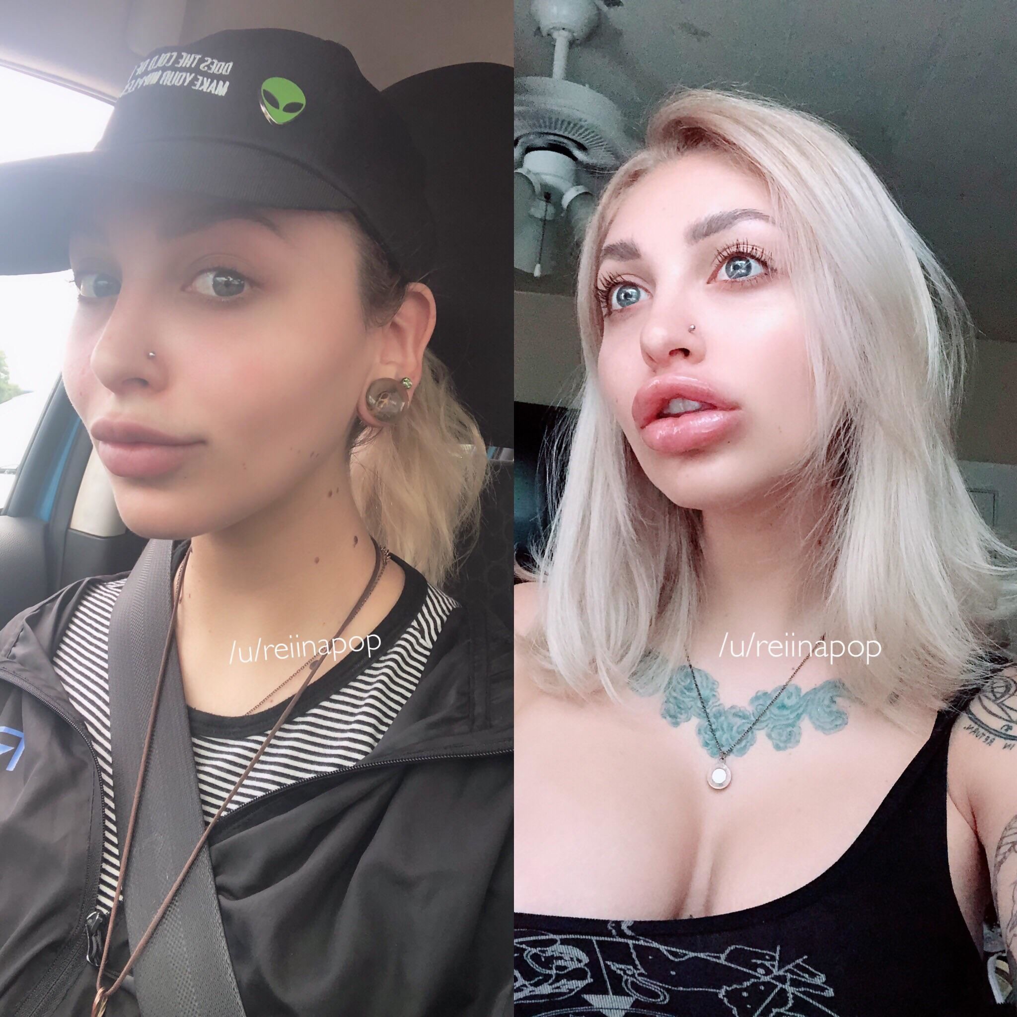 before/after freshly bleached hair + 1 syringe juvederm ultra plus ...