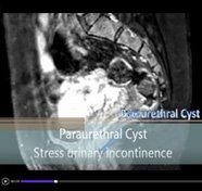 Surgical management of female paraurethral cyst with concomitant ...