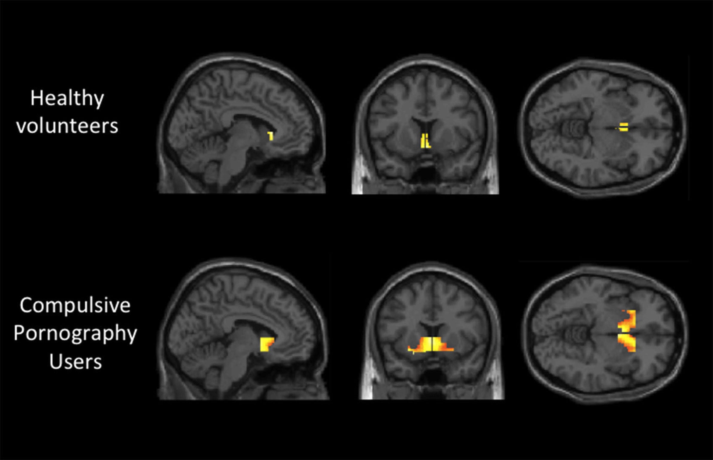 Pornography addiction leads to same brain activity as alcoholism ...