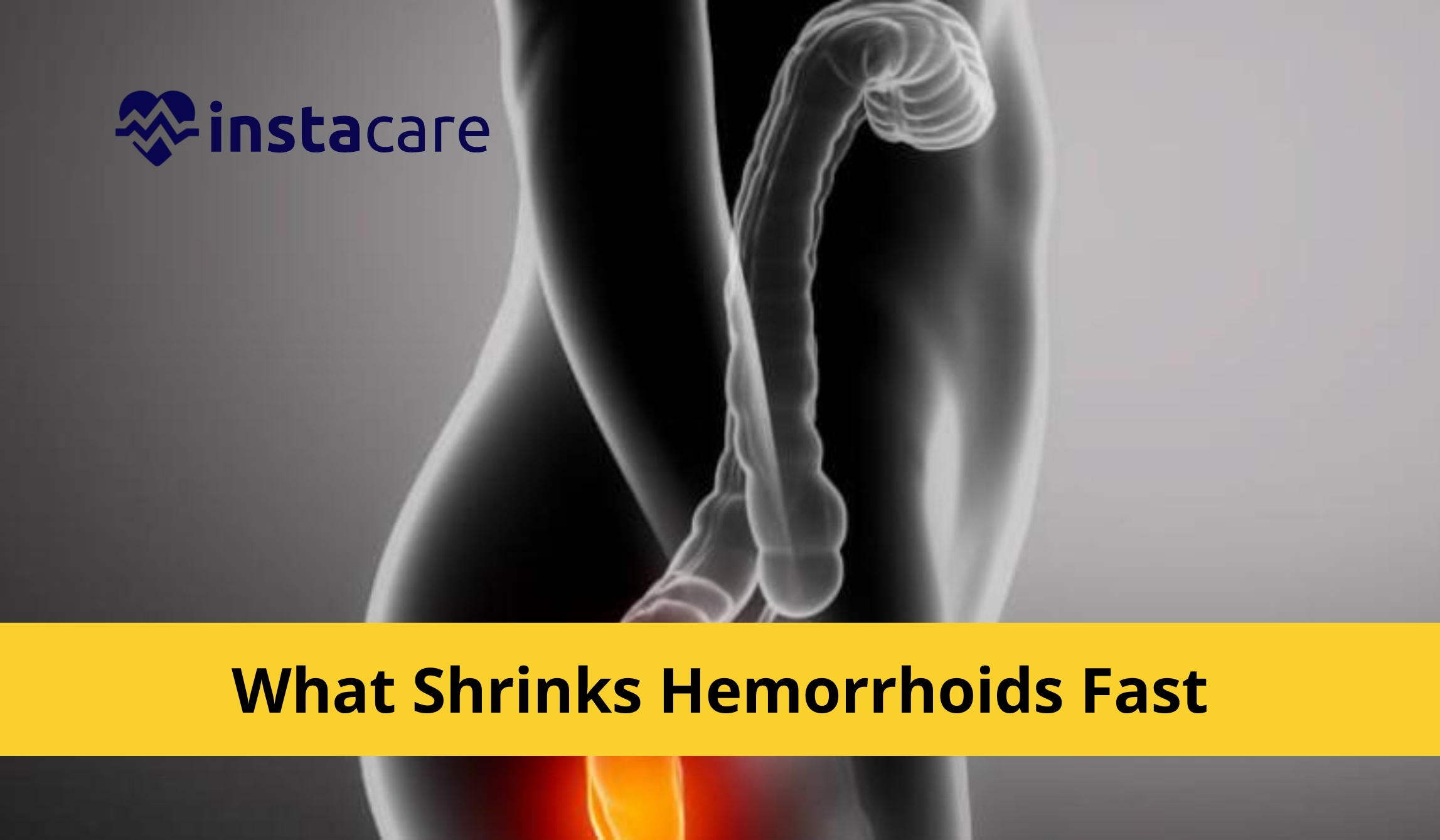 What Shrinks Hemorrhoids Fast? Preventions And Treatments