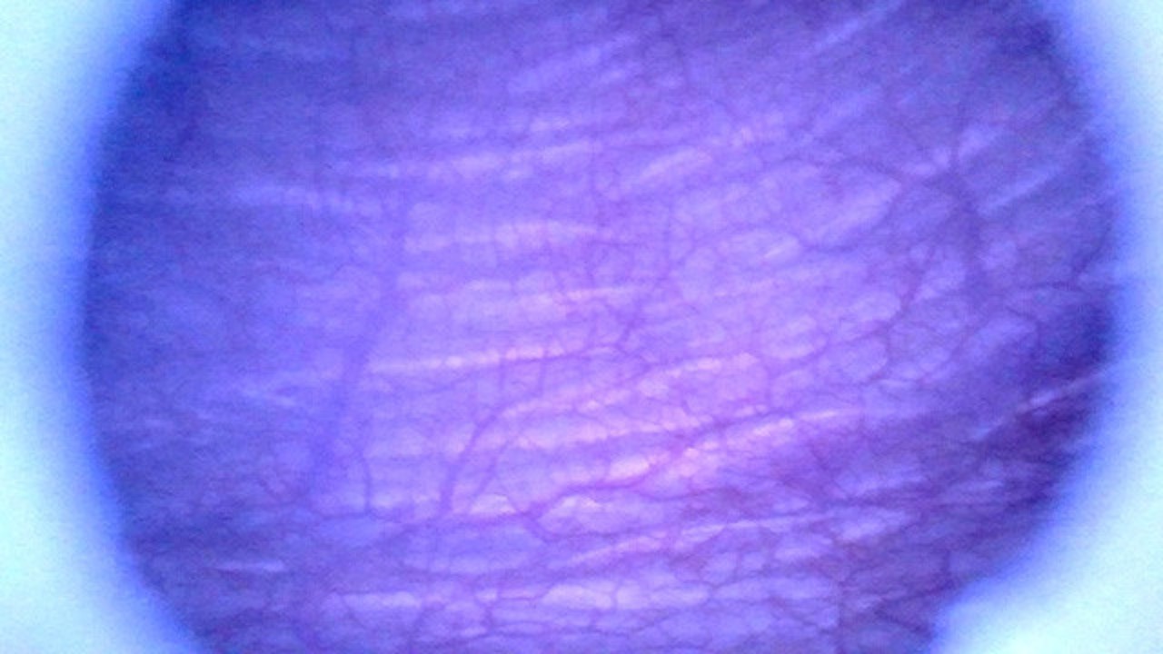 Beautiful inside POV of my Full Bladder with the Endoscope ...