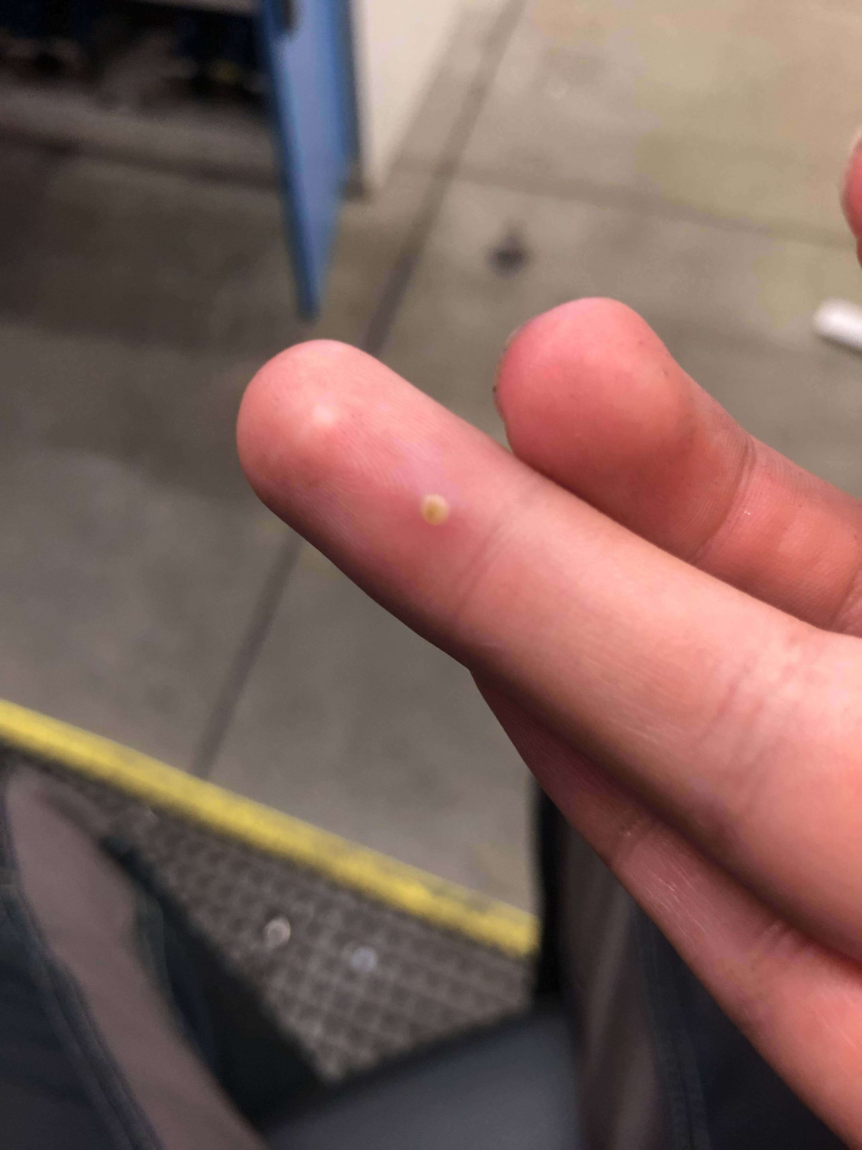 I pricked my finger through a glove two days ago. Should I be ...