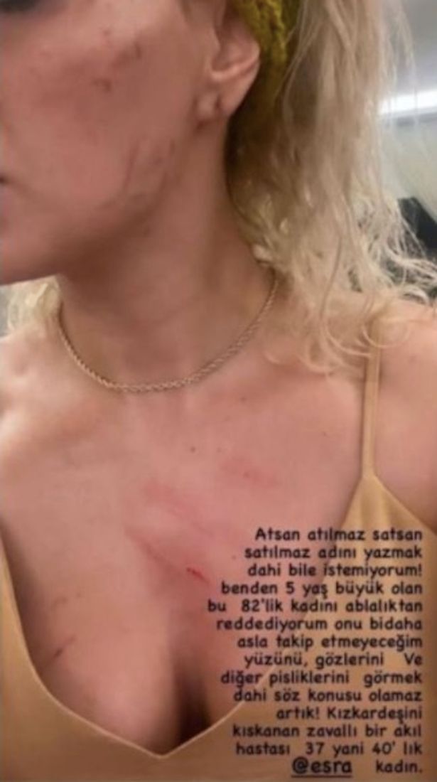 Bombshell blonde influencer shows off injuries after vicious ...