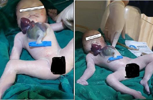 This baby was born with multiple serious defects: ectopia cordis ...