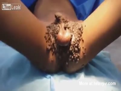 Genital Warts Videos - Free Porn Videos